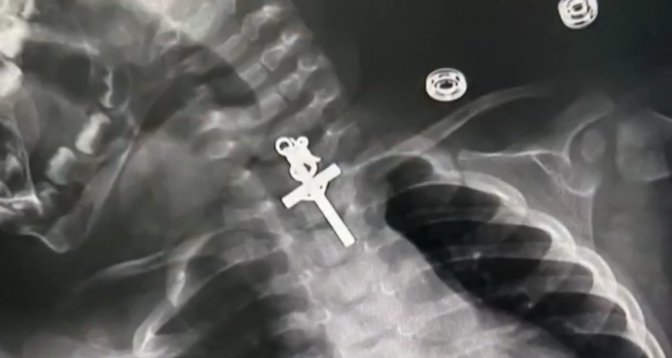 Bebé es operada de urgencia en Perú tras tragarse un crucifijo de metal: se le alojó en el esófago