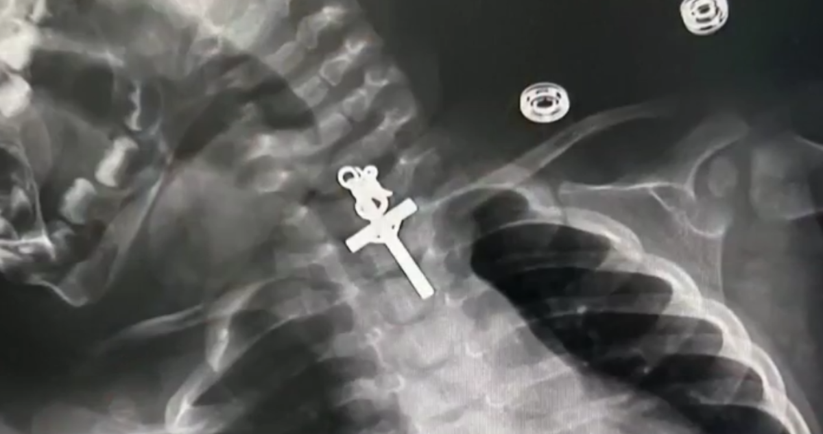 Bebé es operada de urgencia en Perú tras tragarse un crucifijo de metal: se le alojó en el esófago