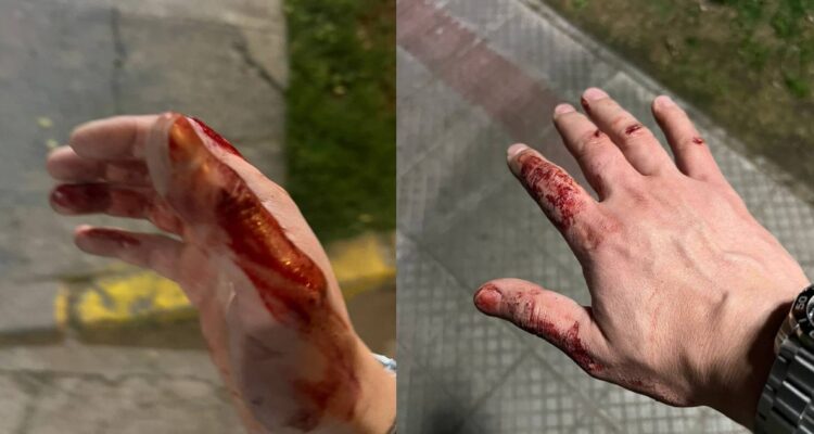 “Fractura de pómulos y esguince”: pasajero denuncia agresión de chofer de aplicación en Providencia