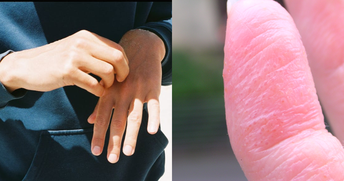 Dishidrosis