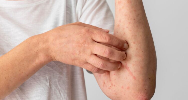 Qué es la escabiosis, también conocida como sarna, cómo se contagia, cuál es su tratamiento y cómo reconocer los síntomas en la piel.