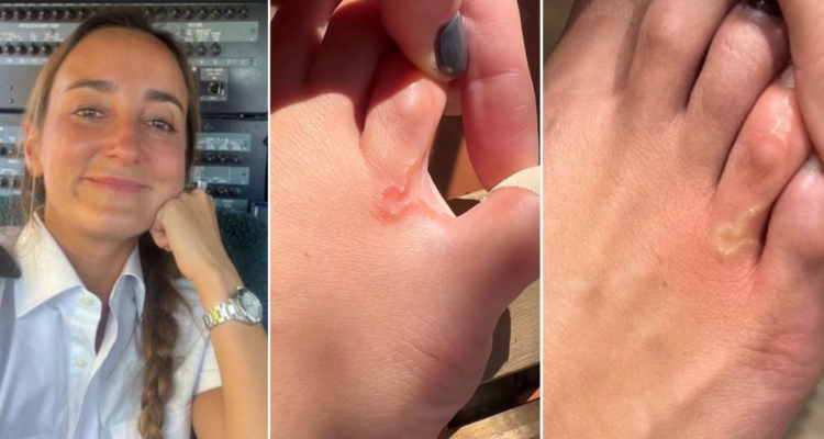 Influencer halla gusano vivo en su pie