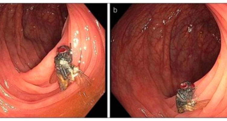 Encuentran una mosca intacta en los intestinos de un hombre de 63 años durante examen rutinario