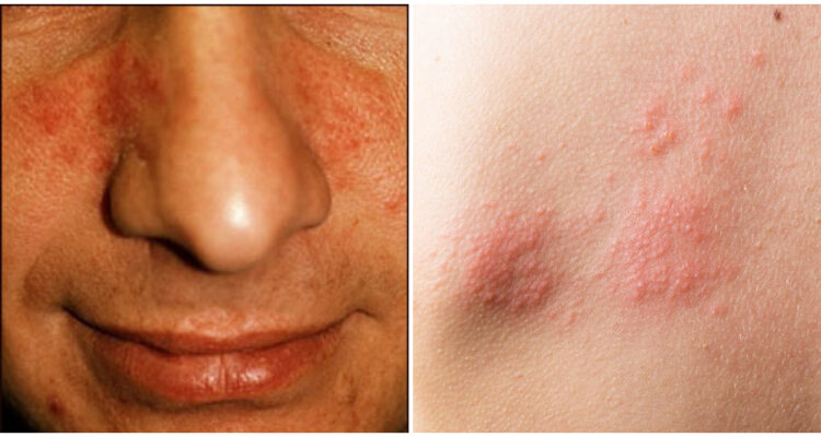 Enfermedades psicosomáticas en la piel: rosácea y dermatitis atópica.