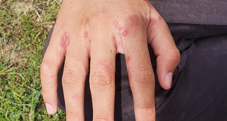 Alerta por brote de Escabiosis (sarna) en La Serena y Coquimbo