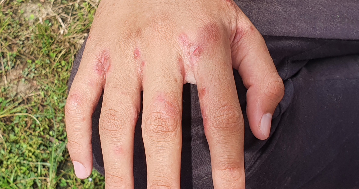 Alerta por brote de Escabiosis (sarna) en La Serena y Coquimbo