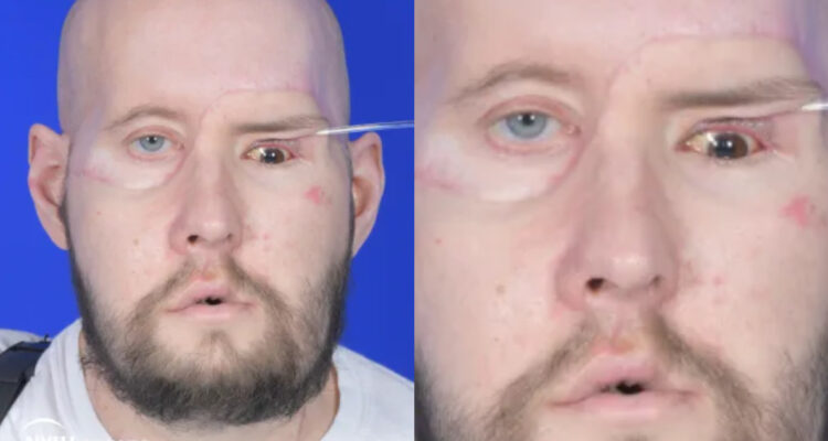 Cirujanos realizan el primer trasplante de ojo completo en la historia: ¿recuperó la visión?