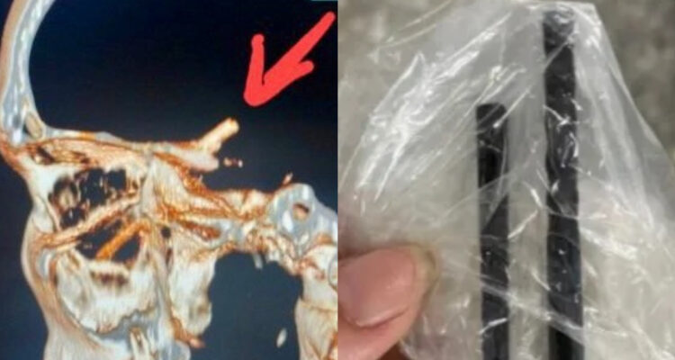 Hombre de 35 años tuvo dolor de cabeza por 5 meses y descubrió que tenía palillos chinos en el cerebro