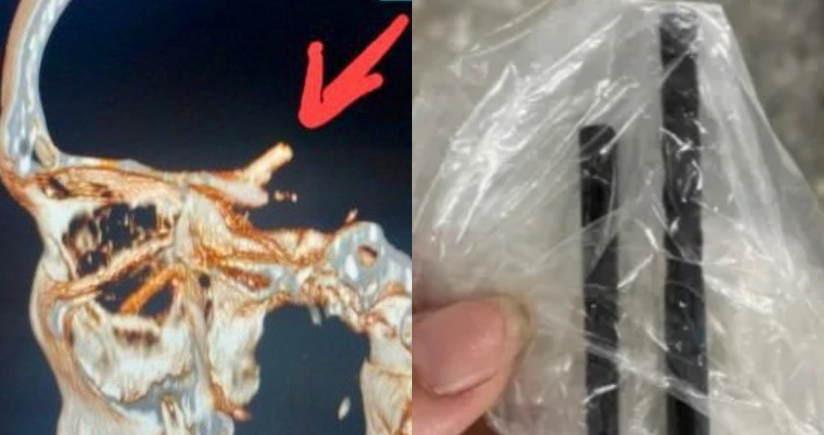 Hombre de 35 años tuvo dolor de cabeza por 5 meses y descubrió que tenía palillos chinos en el cerebro