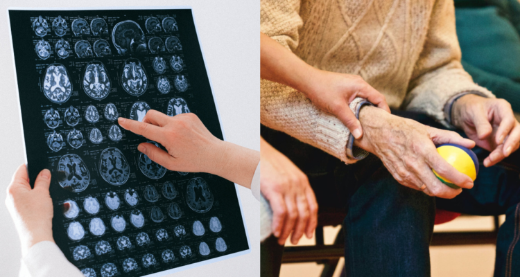 Descubren que el Alzheimer posee variantes: hallazgo podría ser crucial para desarrollar tratamientos