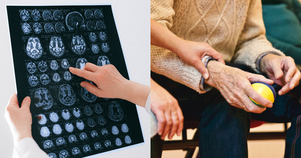 Descubren que el Alzheimer posee variantes: hallazgo podría ser crucial para desarrollar tratamientos