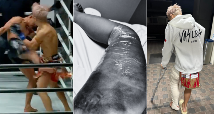 Las brutales patadas que dejaron con la pierna destrozada a peleador de Kickboxing.