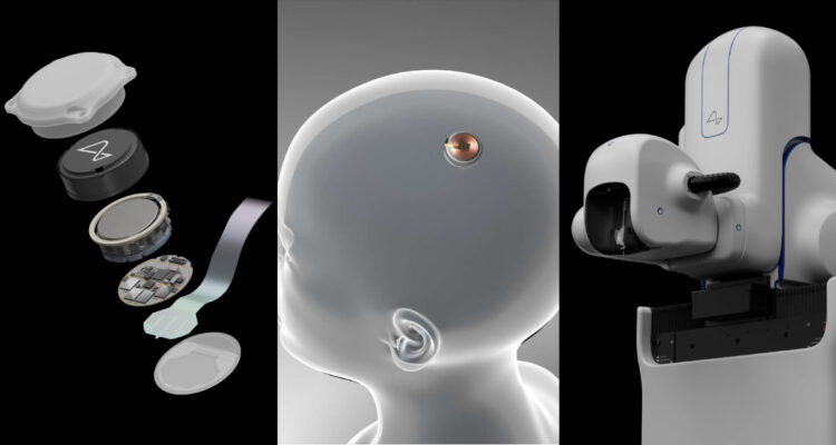 ¿Cómo funciona el implante cerebral de Neuralink que está siendo probado por primera vez en un humano?