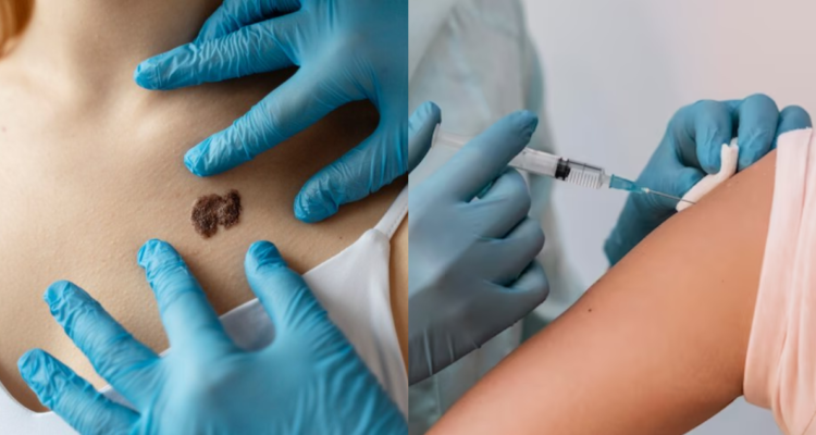 vacuna cáncer de piel