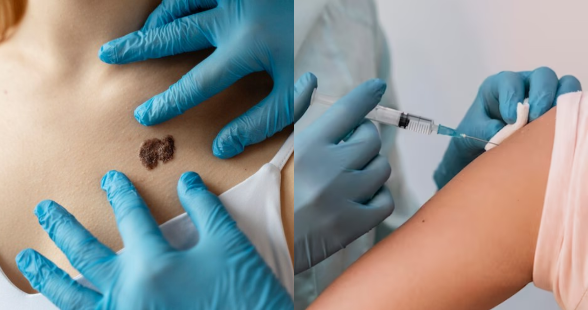 vacuna cáncer de piel