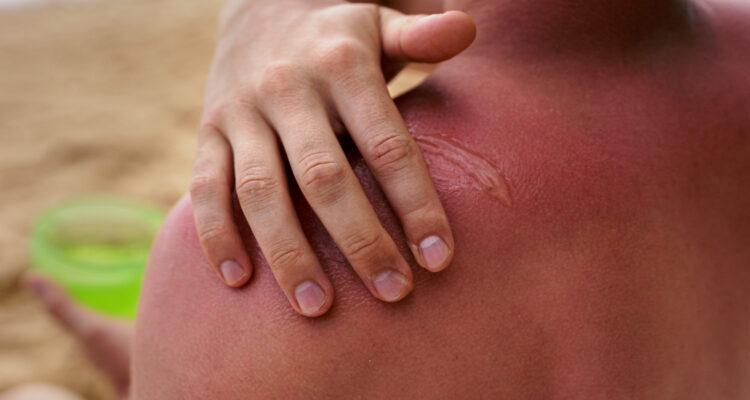 quemaduras solares