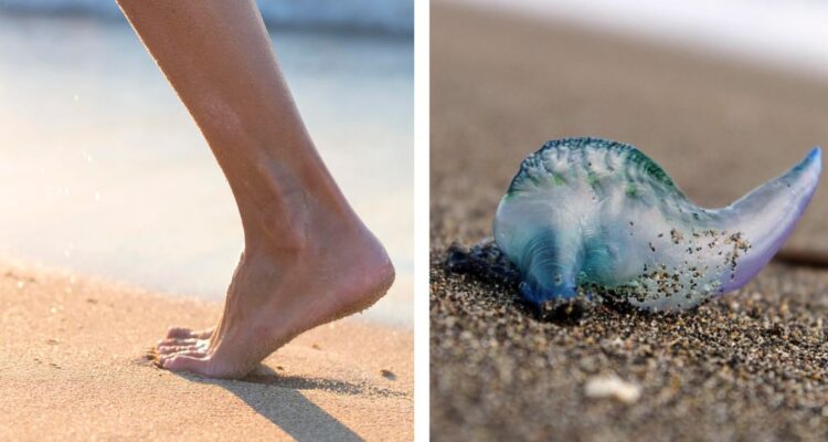 Qué hacer en caso de que te pique o con una picadura de Fragata Portuguesa ¿Se debe aplicar orina sobre la herida o es un mito?