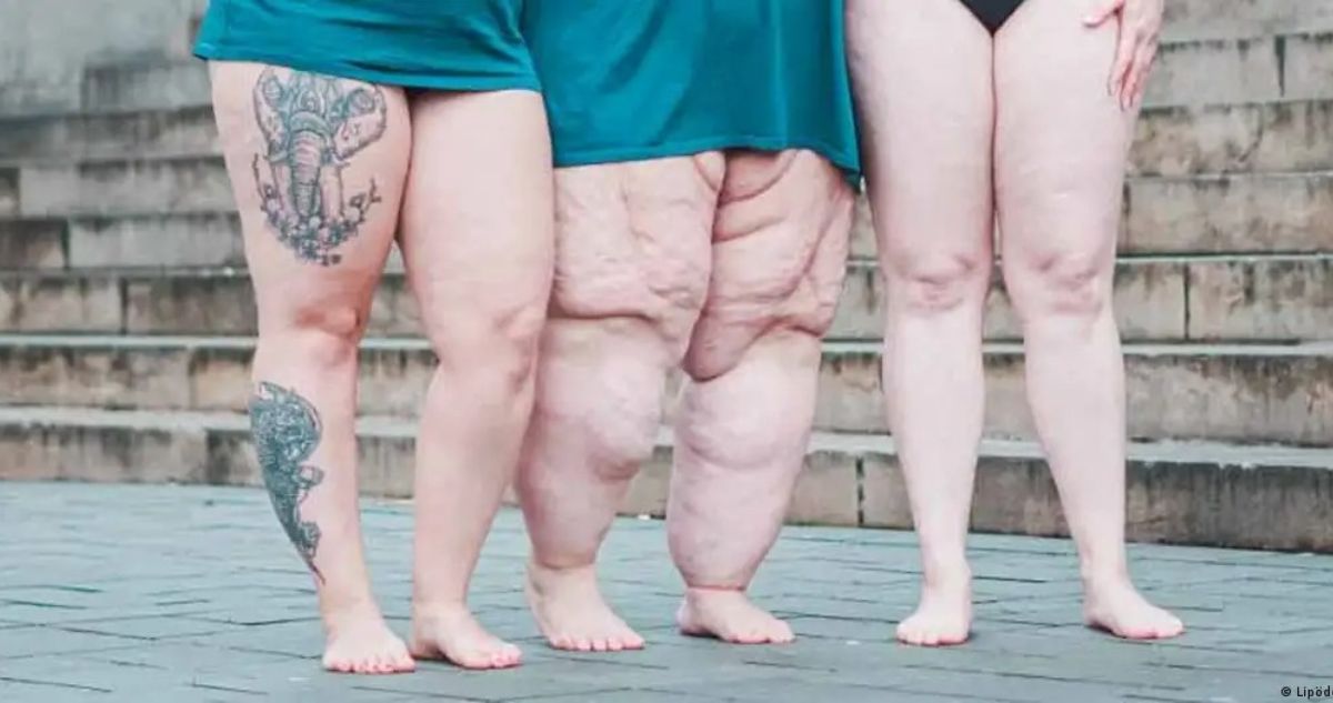 Qué es la lipedema, la enfermedad sin cura que afecta mayoritariamente a mujeres y que se confunde con obesidad. ¿Cuáles son sus síntomas y tratamiento?