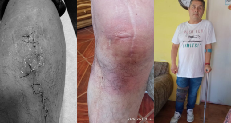 hombre acusa negligencia médica en intervenciones a su rodilla en Concepción