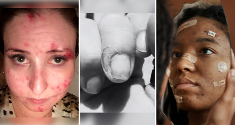 De sacar “cueritos” a la autolesión inconsciente: dermatilomanía, la compulsión por arrancarse la piel