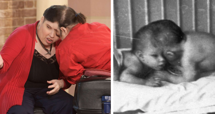 Gemelos siameses fallecieron