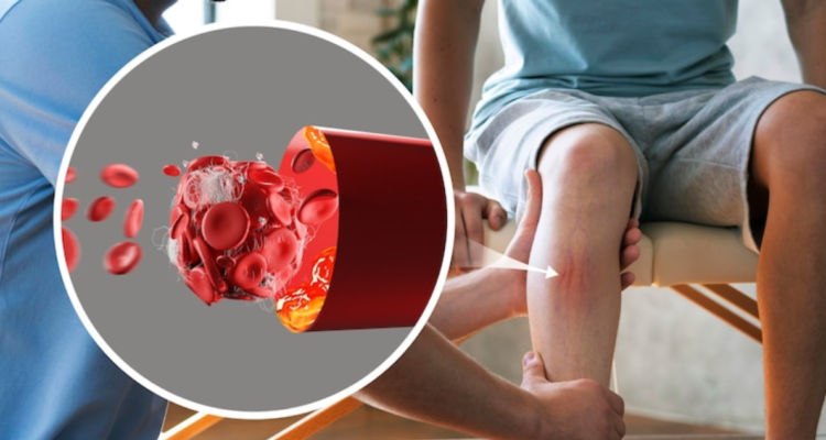 Trombosis con Trombocitopenia