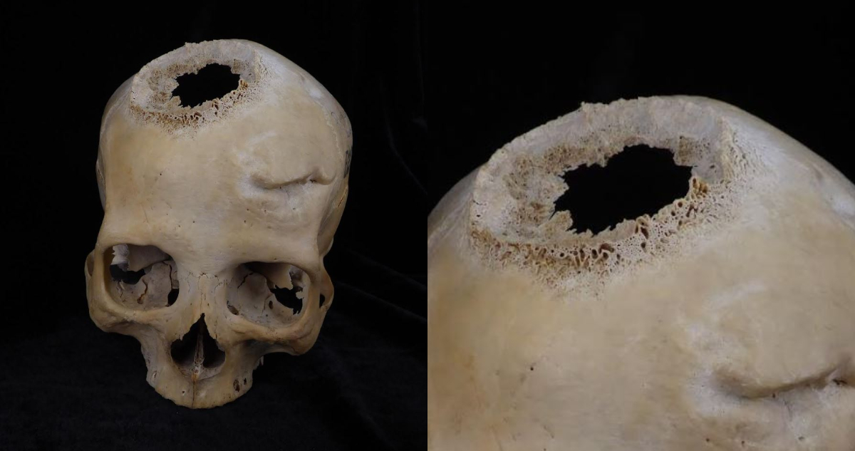 Encuentran cráneo del Antiguo Egipto que evidencia la primera operación por cáncer hace 4.500 años