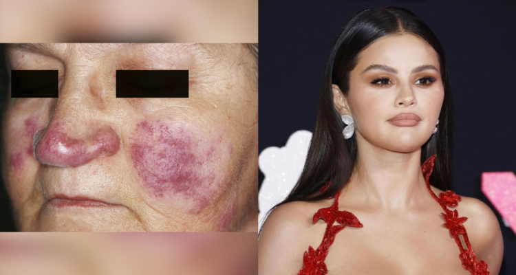 Día Mundial del Lupus: ¿En qué consiste la enfermedad autoinmune que padece Selena Gómez