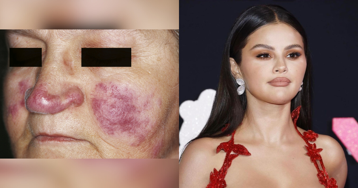 Día Mundial del Lupus: ¿En qué consiste la enfermedad autoinmune que padece Selena Gómez