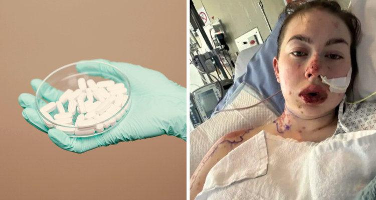 Un mujer en Nueva Zelanda sufrió una reacción alérgica tras tomar el fármaco Lamotrigina para tratar la depresión. Este efecto es uno, del poco conocido Síndrome de Stevens-Johnson (SJS).