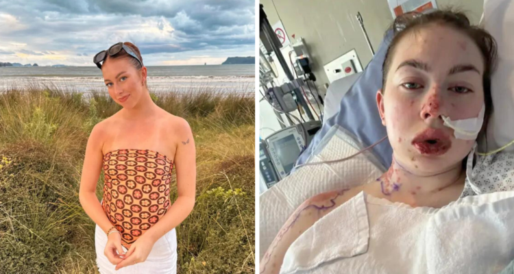 Una mujer en Nueva Zelanda formó ampollas en su cuerpo, al tomar un medicamento para la depresión que le provocó una reacción alérgica.