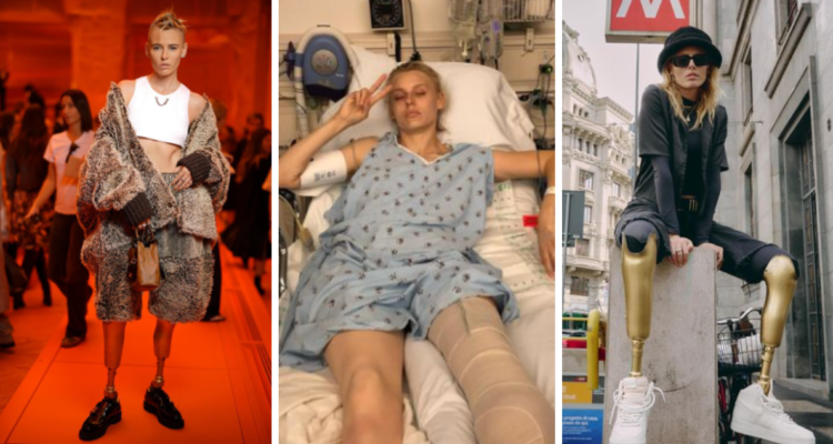 Una modelo perdió la mitad de sus dos piernas, debido al síndrome de shock tóxico (SST) que sufrió tras usar un tampón.