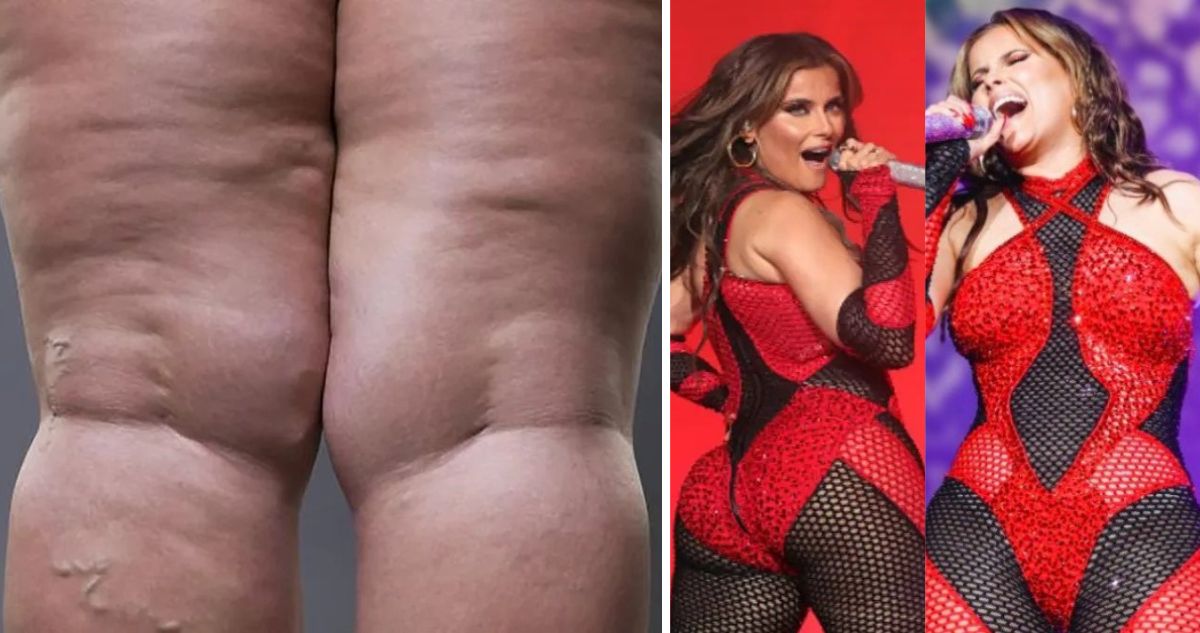 Qué es el lipedema, la enfermedad de Nelly Furtado, cuáles son sus síntomas y señales y cuál es el tratamiento que no es para la obesidad.