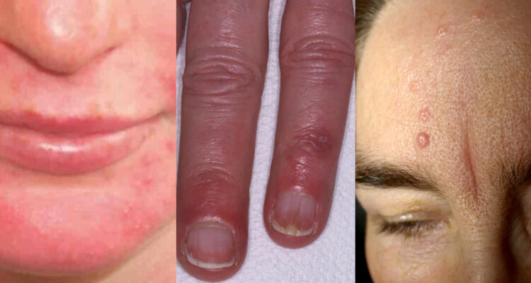 Problemas en la piel ocasionados por el frío