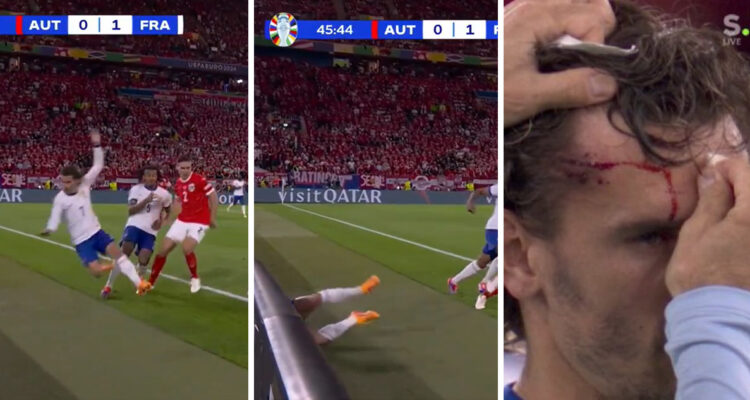 Antoine Griezmann terminó con una gran herida en su frente.