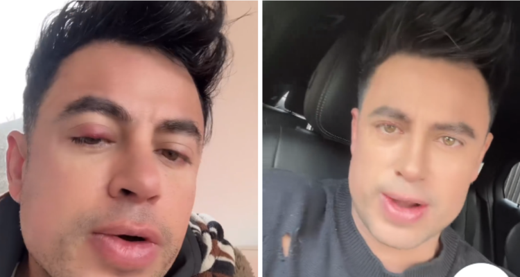 Bruno Zaretti en video cargado en su Instagram mostrando afección a su ojo