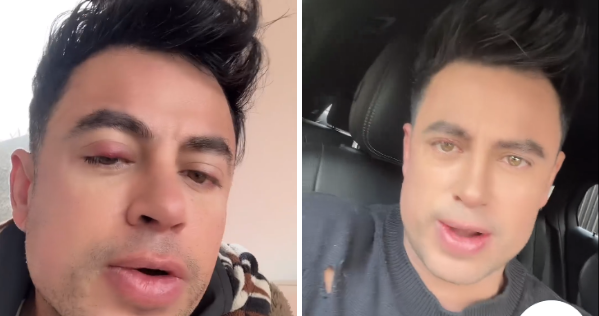 Bruno Zaretti en video cargado en su Instagram mostrando afección a su ojo