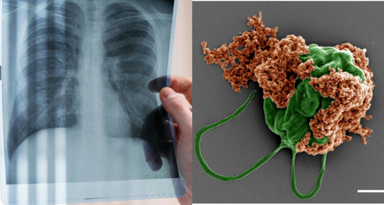 Crean microrobots que entran al organismo y aplican medicamentos contra el cáncer directo en tumores