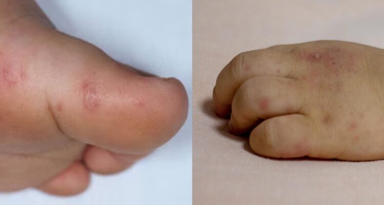 Síndrome boca-mano-pie: cuáles son los síntomas y cómo puedes prevenir el contagio en tus hijos