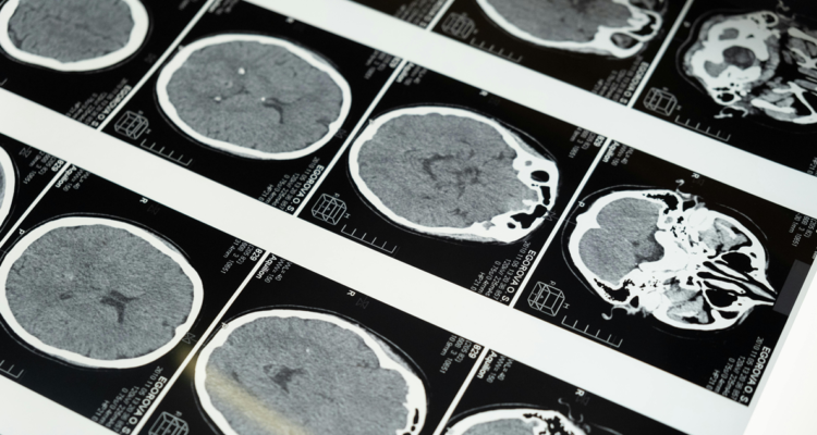 Investigadores identificaron 6 tipos biológicos de depresión y ansiedad que responden de manera diferente a los tratamientos.