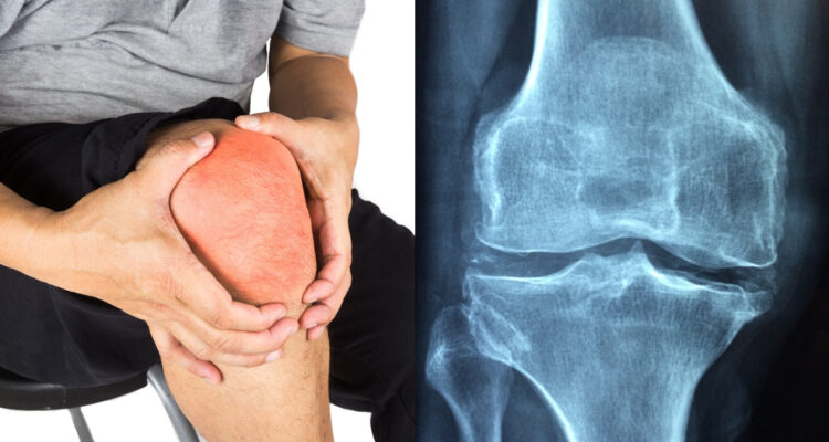 Científicos chilenos crean nuevo método para revertir la artrosis con células de cordón umbilical