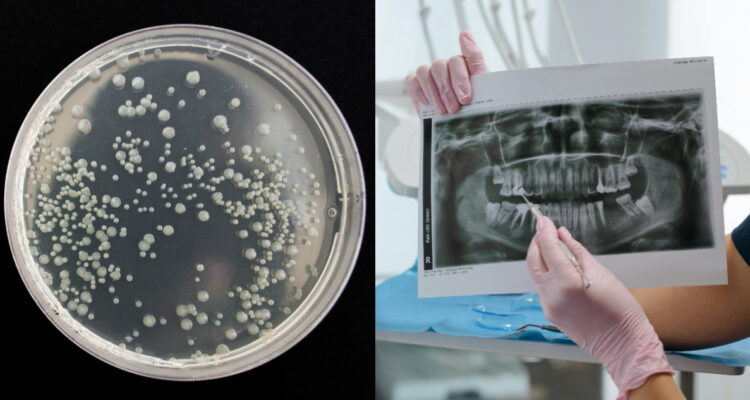 Descubren que una bacteria común de la boca humana puede “derretir” algunos tipos de cáncer