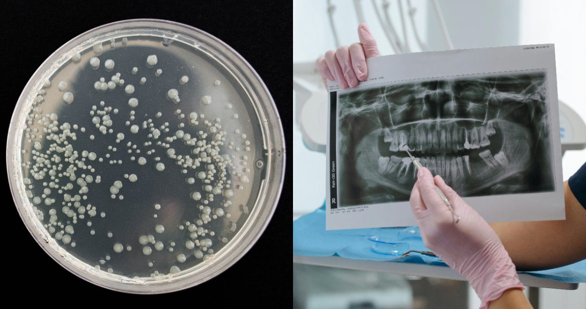 Descubren que una bacteria común de la boca humana puede “derretir” algunos tipos de cáncer