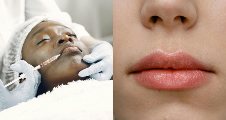 Mitos y verdades sobre el relleno de labios: experta detalla pros y contras del procedimiento estético