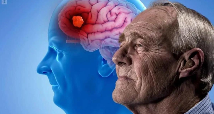 Nuevo tratamiento contra alzheimer