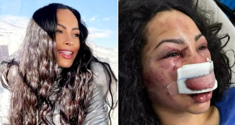 Revelan que mujer brasileña brutalmente agredida en Las Condes recibió alta médica y volverá a su país