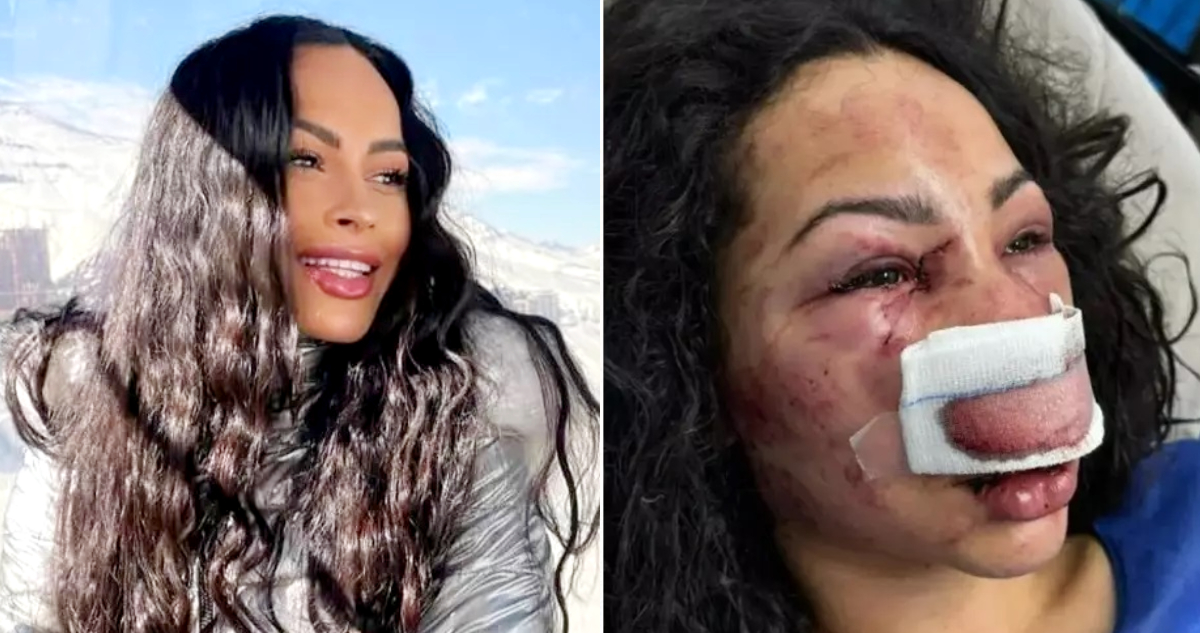 Revelan que mujer brasileña brutalmente agredida en Las Condes recibió alta médica y volverá a su país