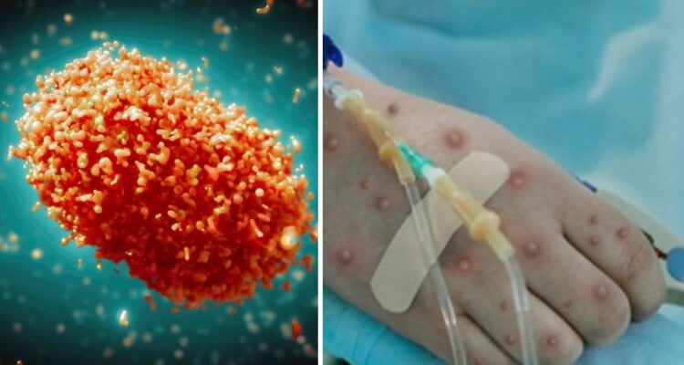 Qué significa la Alerta Sanitaria por la Viruela del Mono en Chile, qué es y qué medidas se pueden tomar para prevenir contagios.