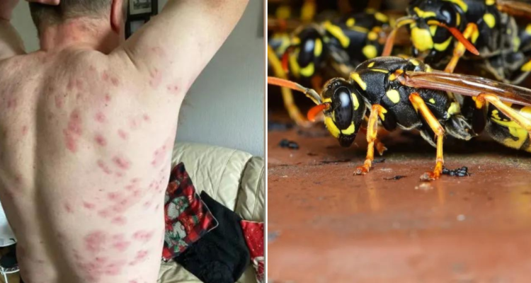 Ataque de avispas a hombre