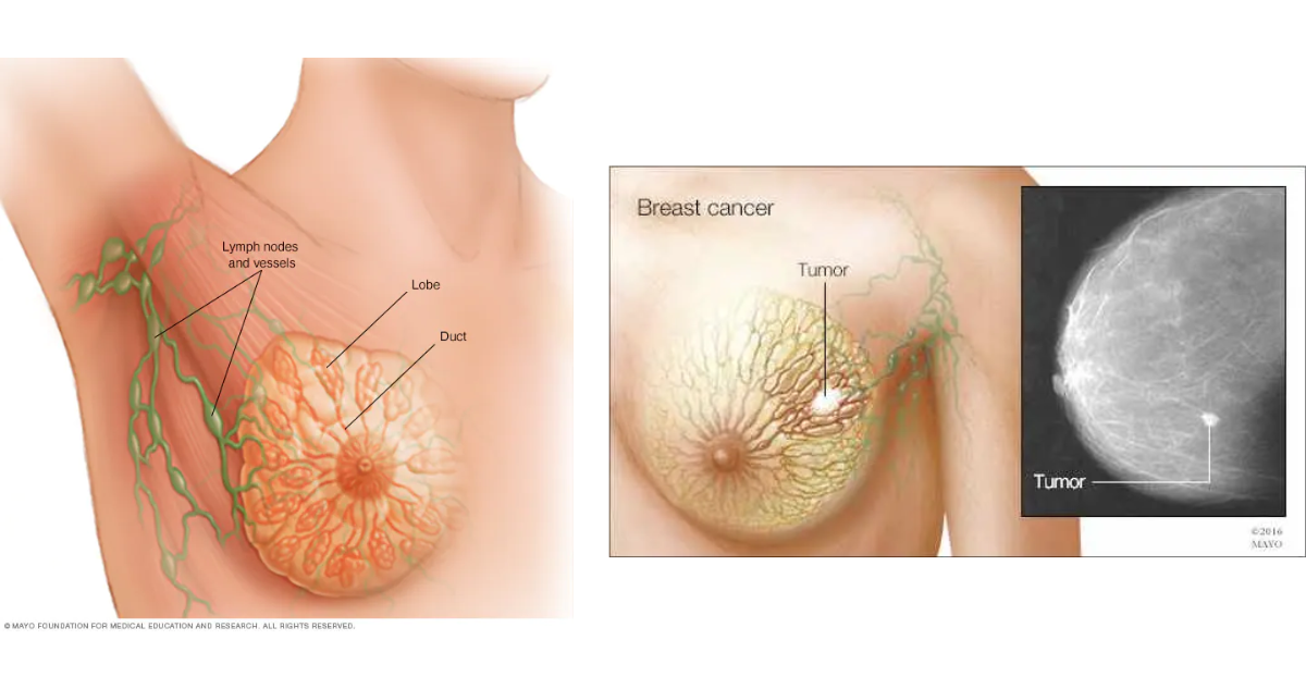 Ilustraciones de tumores de cáncer de mama